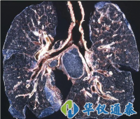 你知道什么是塵肺病嗎？使用粉塵儀可以降低塵肺病的發(fā)生率